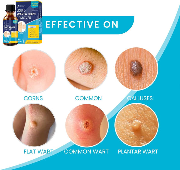 GENITAL WART REMOVAL OINTMENT