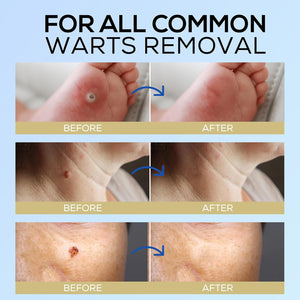 Fast-Acting Wart Remover Cream: Salicylic Acid Wart Remover for Men Women image 5