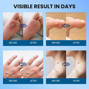 Plantar Wart Remover Pads: Salicylic Acid Wart Remover Bandaid image 2