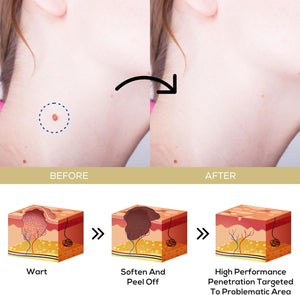 Fast-Acting Wart Remover Cream: Salicylic Acid Wart Remover for Men Women image 2